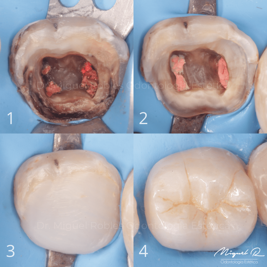 Endodoncia y Corona Dental Estetica Polanco.PNG
