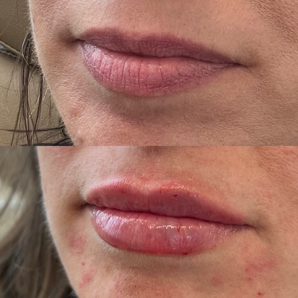 Beautiful, Enhanced &amp; Hydrated lips this Wednesday 💉 
This lovely client came in for rejuvenation with Ashley, and this is just a sneak peek of her pretty face 🫶🏼 still natural looking lips&mdash; just enhanced! And we&rsquo;re lovingggg the c