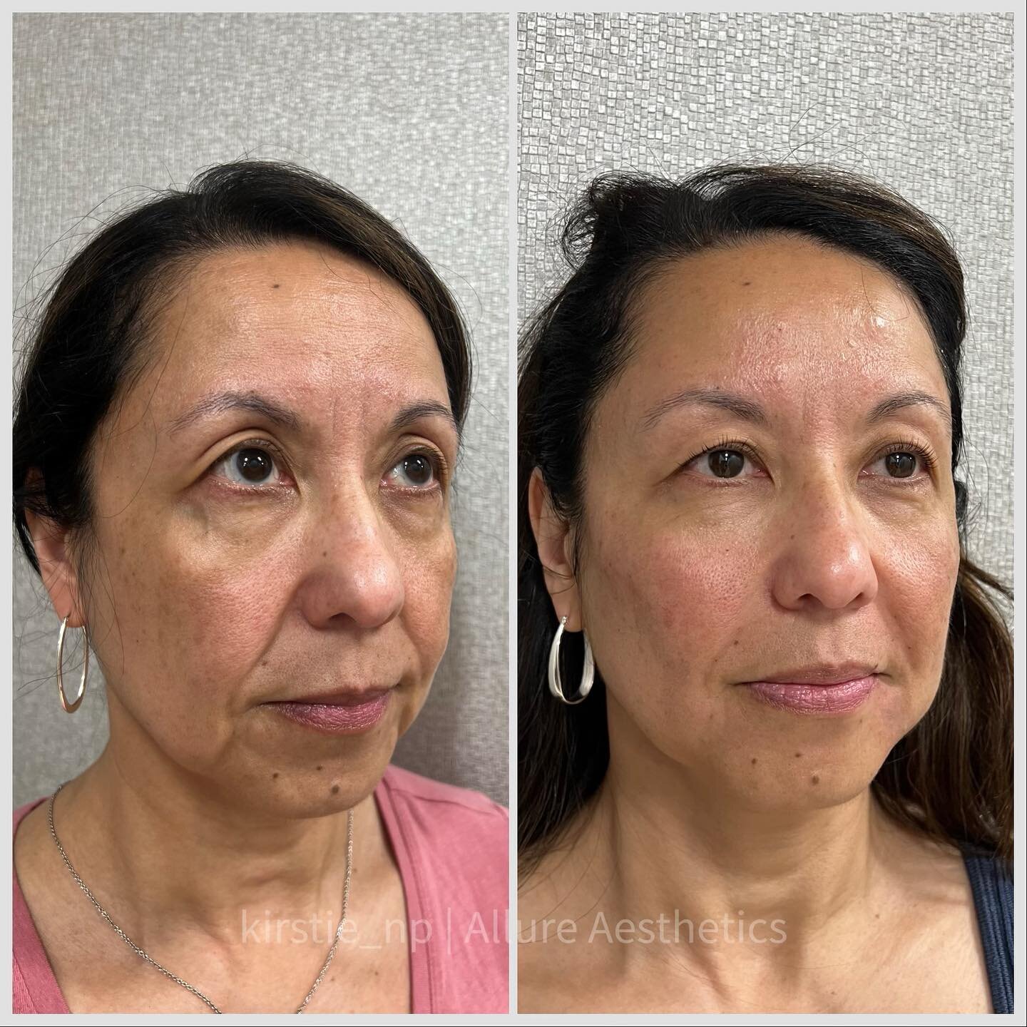 This beautiful lady looks refreshed after her full face rejuvenation 🤍 💉 
Tox was used to smooth the forehead, reduce fine lines and wrinkles.
Filler was used to enhance midface, chin shadows/marionette lines and nasolabial folds for this beautiful