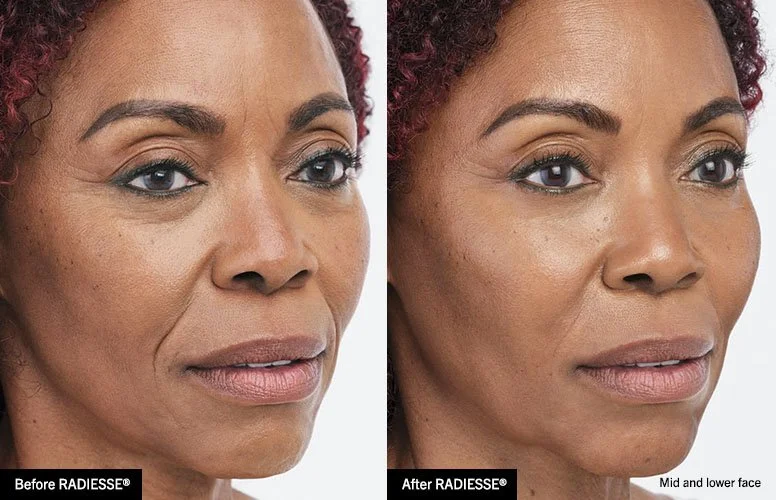 Fillers — Ingleton Dermatology P.C.