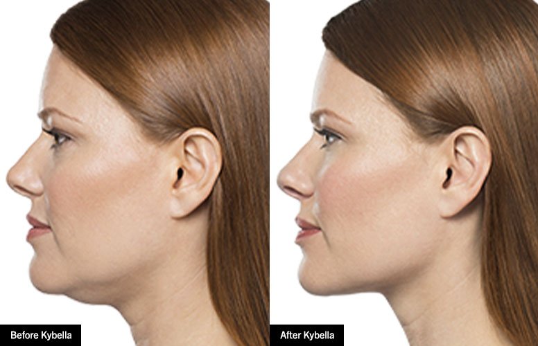 Kybella.jpg