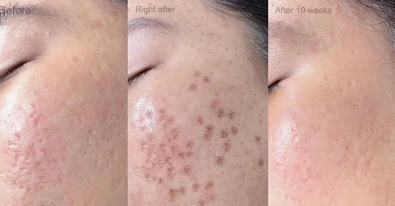 Working on smoothing out those #acnescars
&bull;
#Fibroblastskintightening
&bull;
#PlasmaFibroblast #green #got #nofillersneeded #PlasmaFibroblastSkinTightening #PlasmaLift #primeplasmafibroblast #Fibroblast #plasmafibroblasttraining #plasmafibroblas