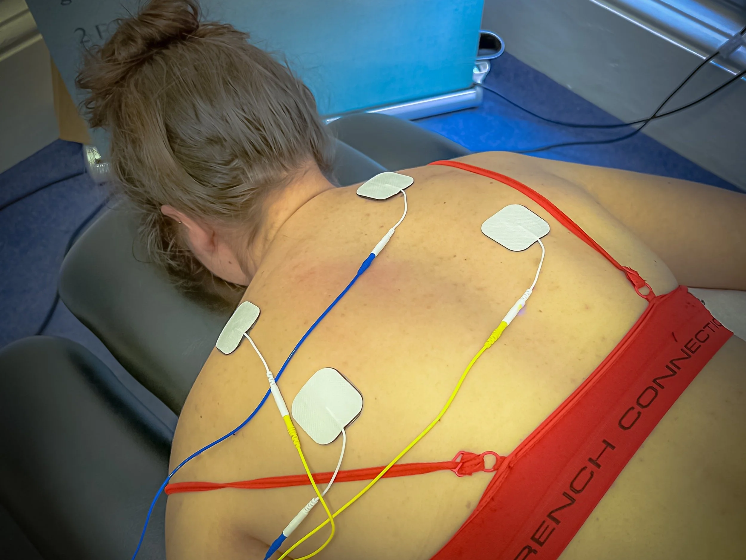 TENS and Interferential Electrotherapy for upper back and shoulders; electrodes on female patient. Spinal Manipulation and Chiropractic alternative.