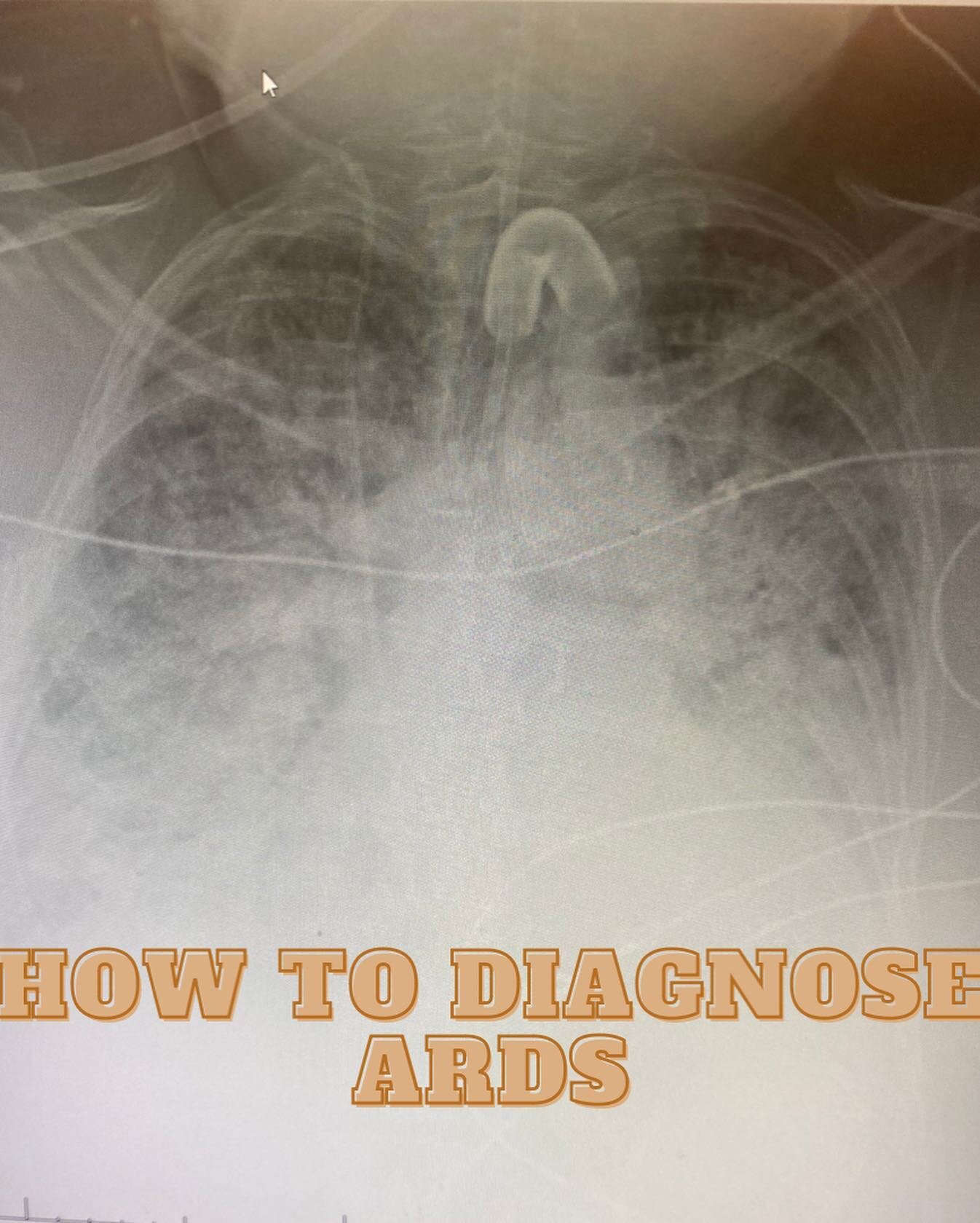 Do you know how to diagnose ARDS or acute respiratory distress syndrome? 

According to the Berlin Criteria ARDS is defined by the following 4 findings: 

1️⃣The onset of the respiratory failure has be an acute onset. Within 1 week of the insult or n