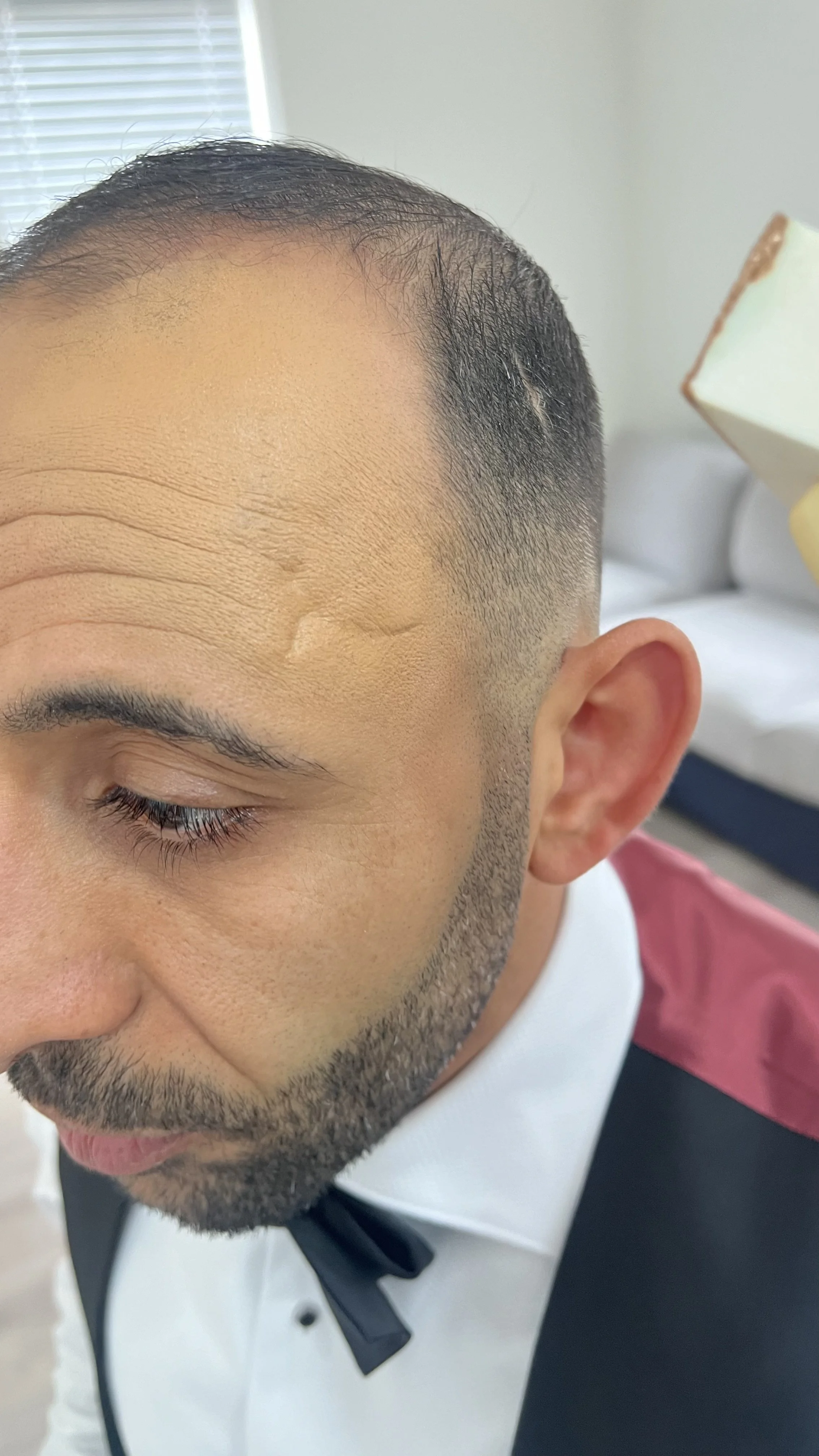 Scar covered and blended