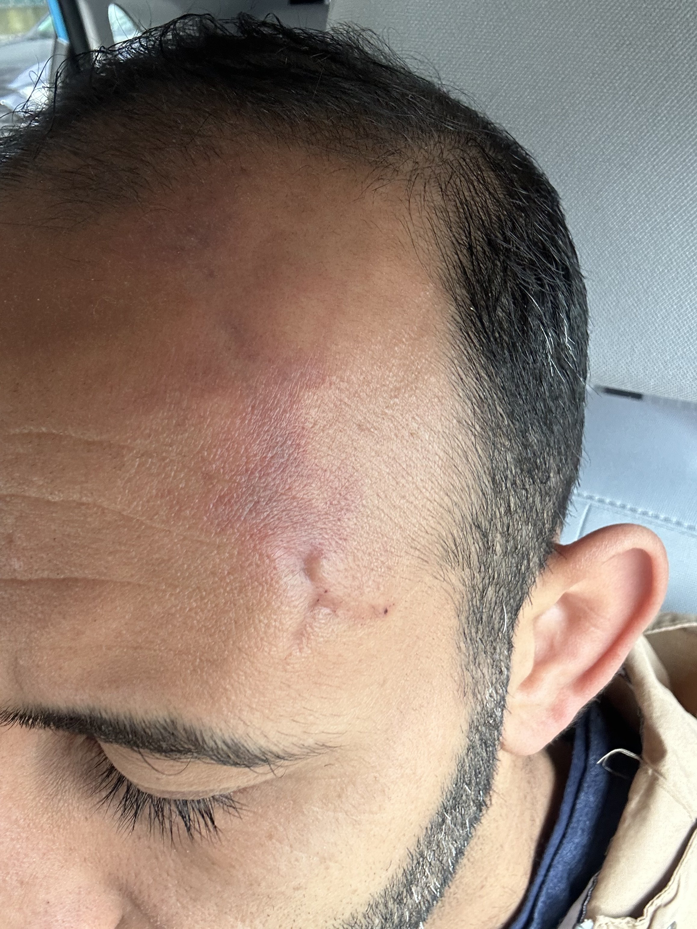 Scar needing coverage and blend-before