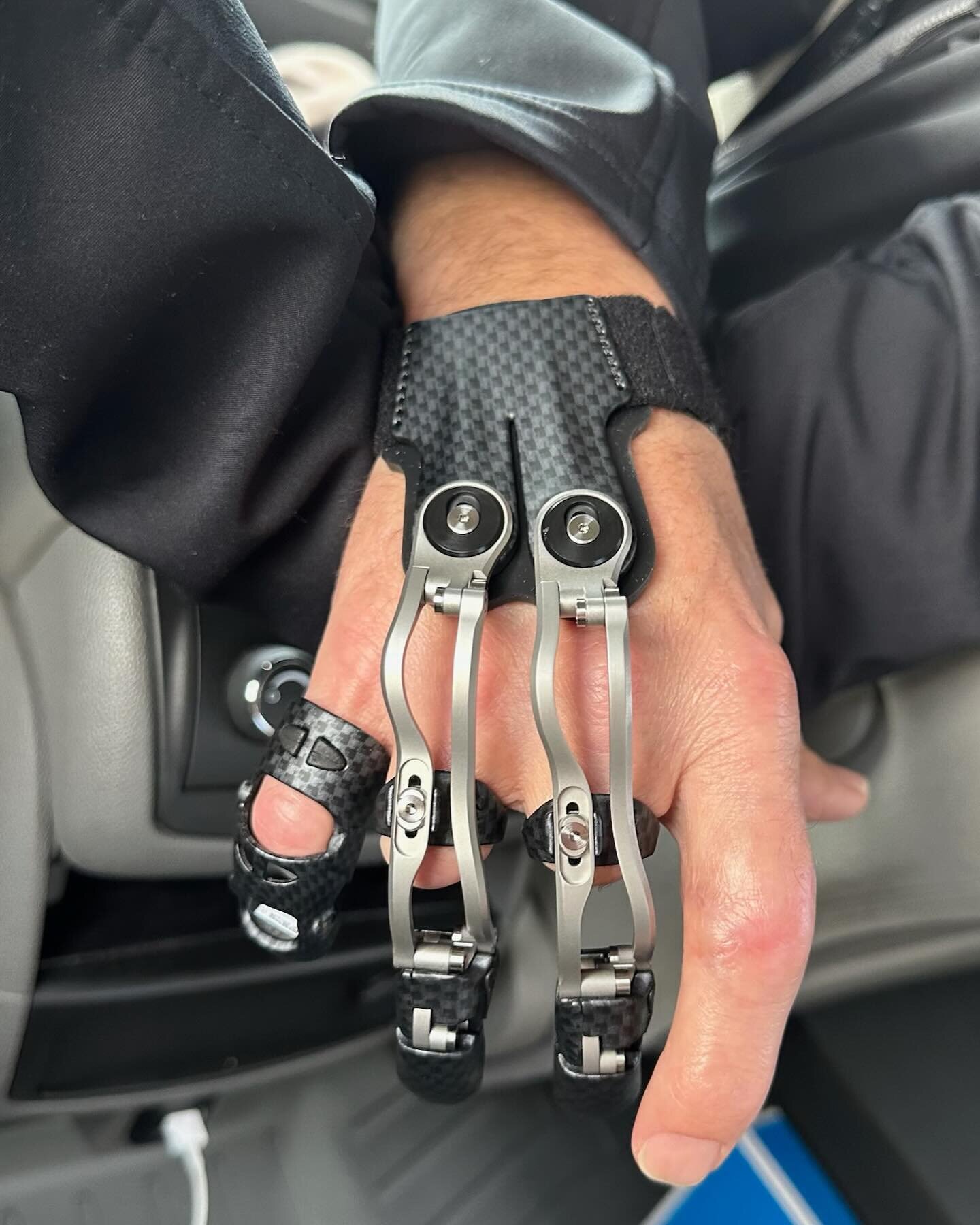 SRT has you covered if you&rsquo;ve experienced any type of amputation.  Often the loss of finger(s) get left untreated but with a prosthetic device, grip strength and finger dexterity can be regained!  Consultations are always free at SRT so don&rsq