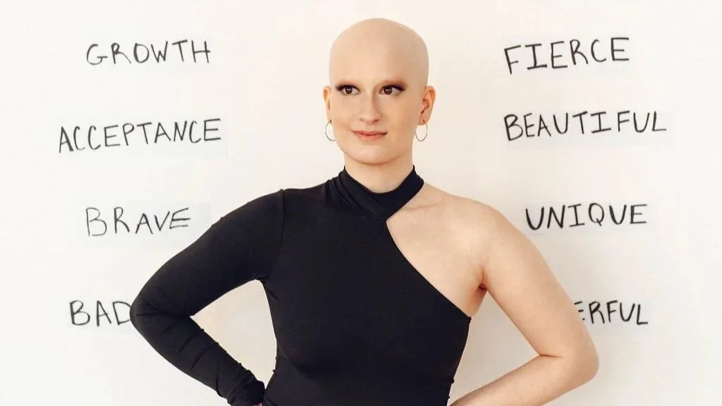 living with alopecia areata