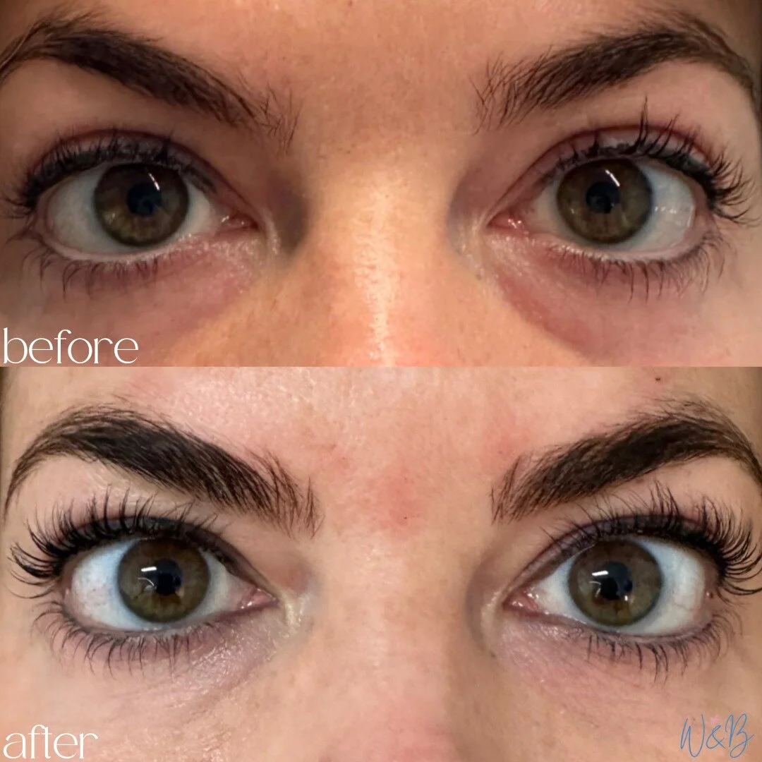 Prf under eyes near me