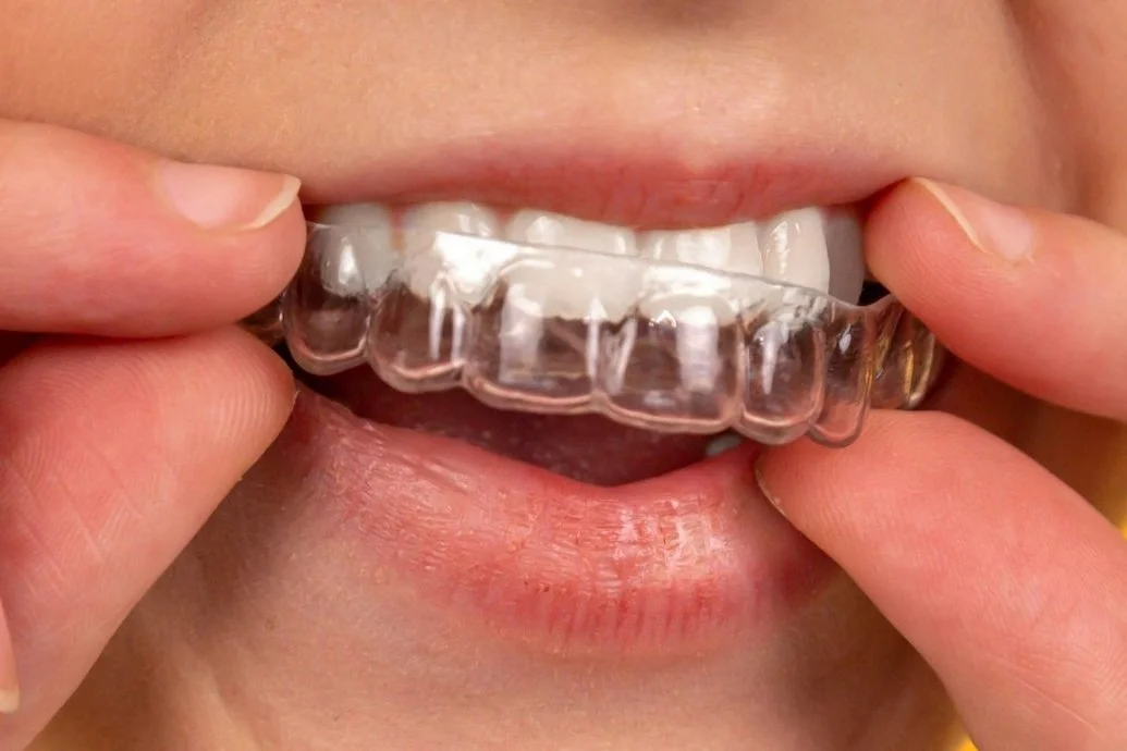 Essix Retainers