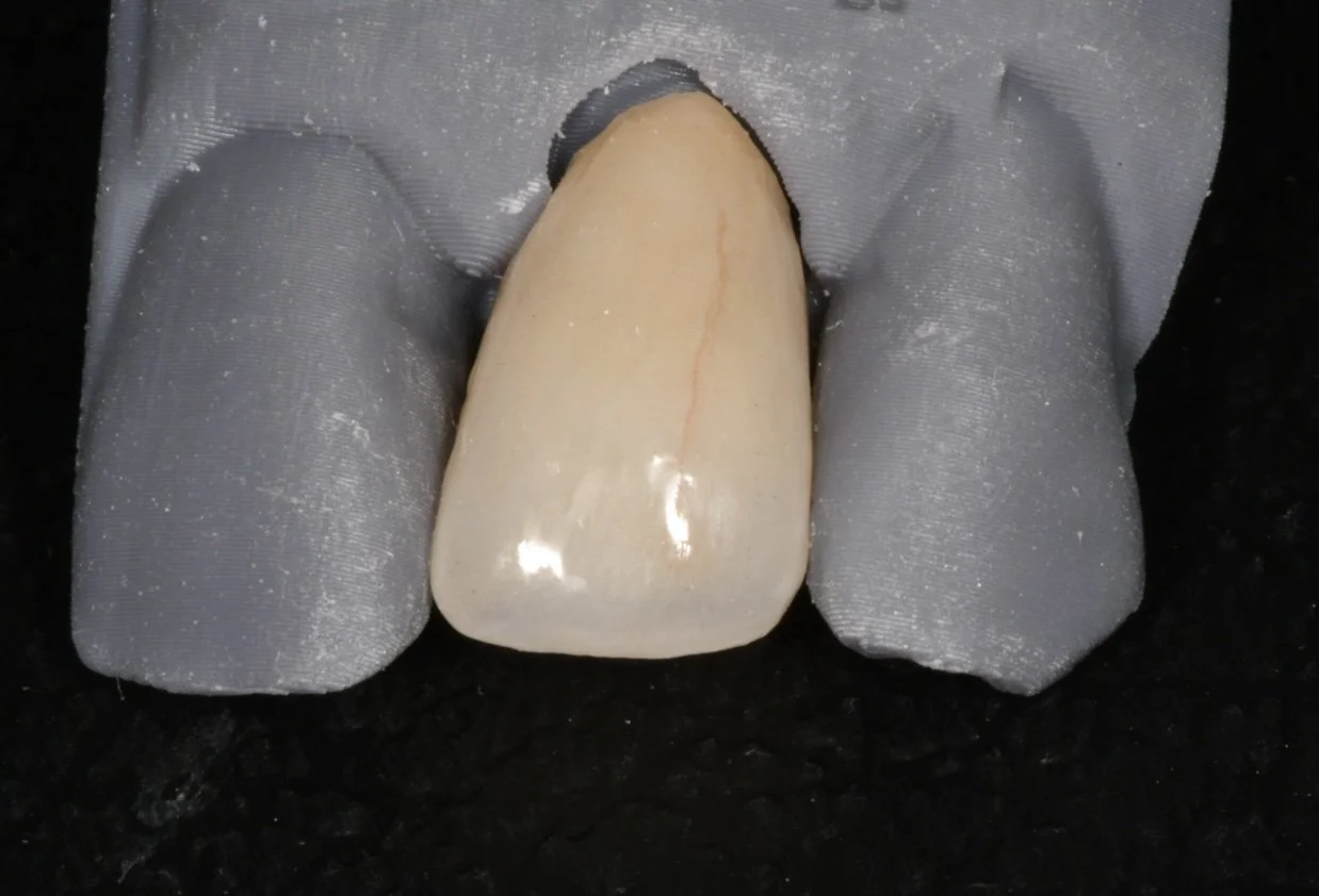 Zirconia Crowns
