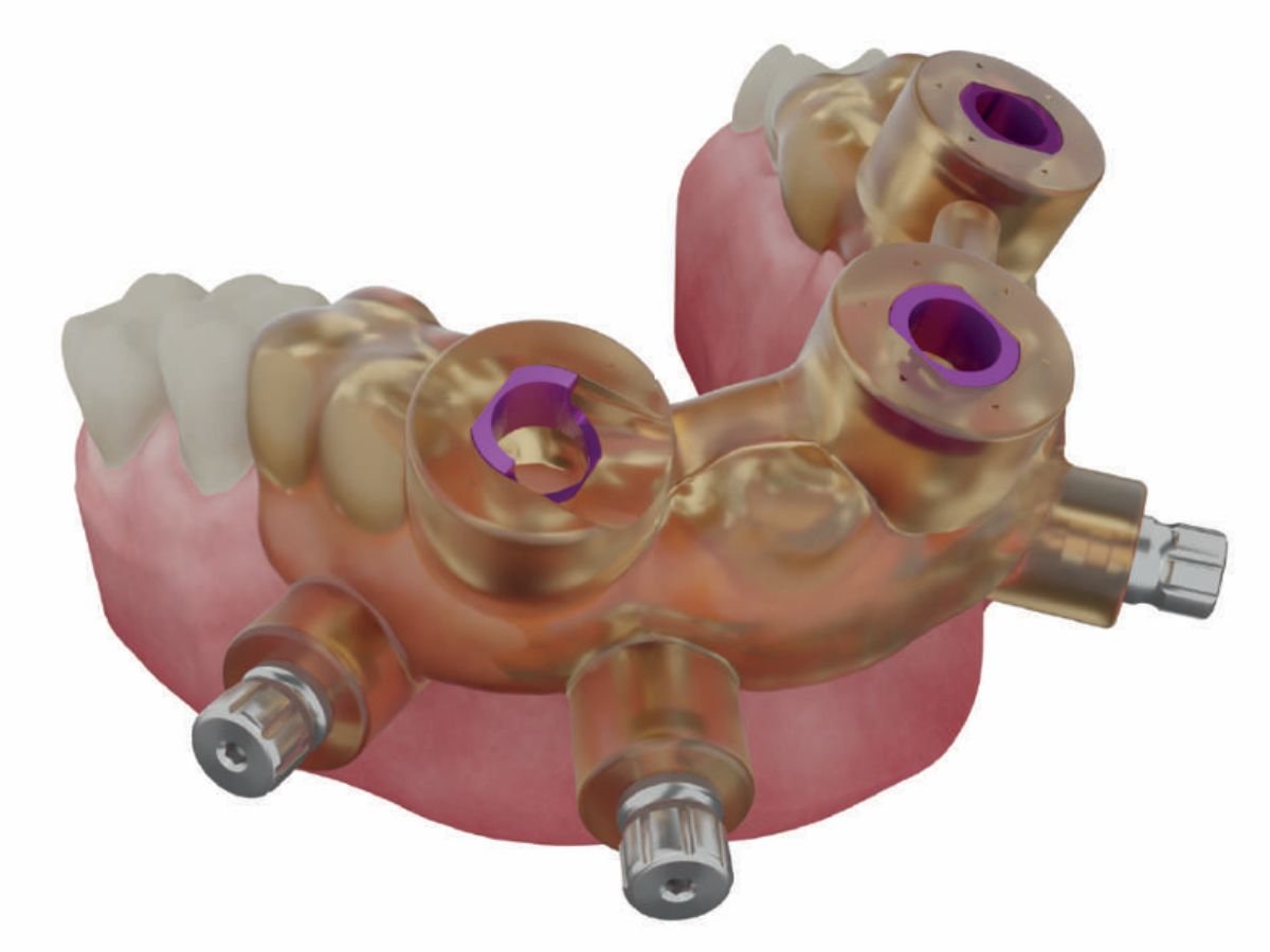Dynamic Abutment Solutions Guided DAS Surgical Kit Universal System 7.jpg