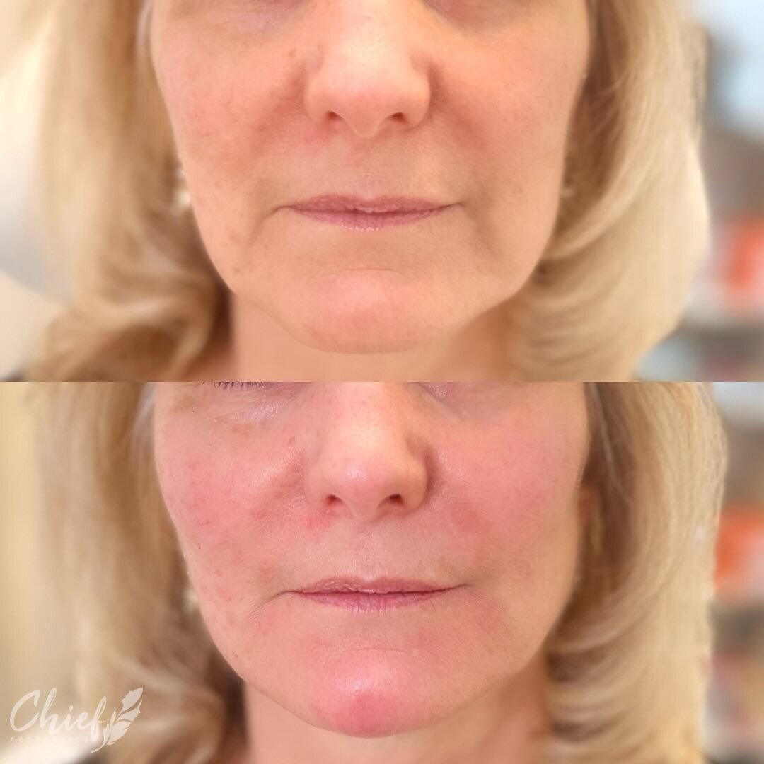 Our focus was to smooth out the deep creases in the lower face and give definition to the chin and pre jowl area of the jawline. 

💉Here I used @radiesse dermal filler and collagen stimulator a few different ways. 

1. Lifted the medial aspect of he