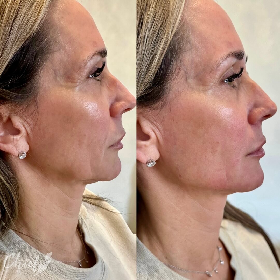 Our focus was jawline and low face. 

As we age, jaw volume decreases, soft tissue of the lower face has less support, resulting in a softer appearance and sagging skin. 

The goal was to give a defined look along with structure and support back to t