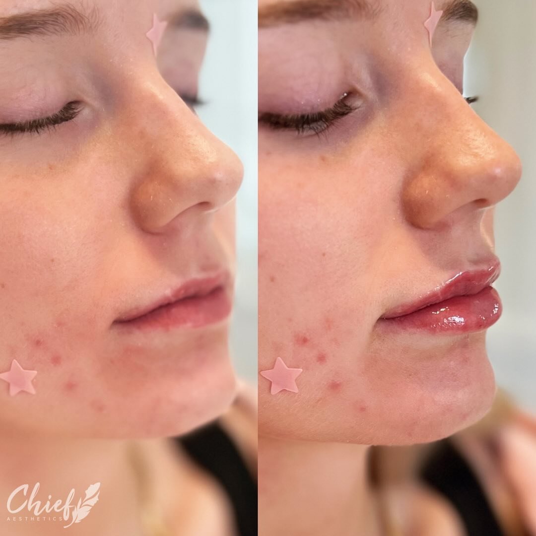 The perfect lip 👄 for this newbie. 

Have you always wanted fuller, more noticeable lips? If so, lip injections could be the perfect treatment for you to achieve the lips you&rsquo;ve always wanted. 

Book your consultation appointment today!
#lips 