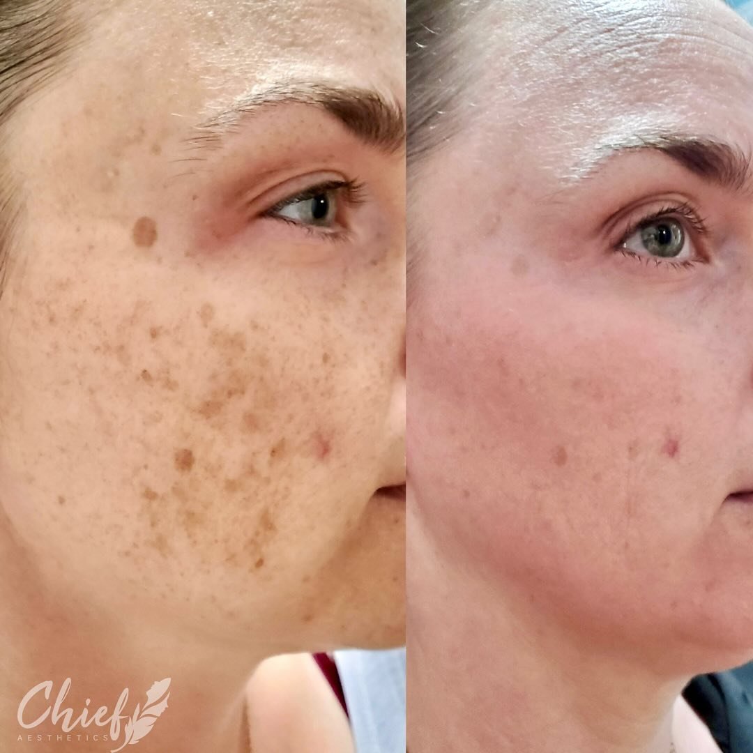 🔹Skincare Post

🔹This patient had concerns with hyperpigmentation and uneven skin tone.  She is an avid outdoor runner where the outside elements can take a toll on your skin. 

🔹These photos are showing ONLY about 6 weeks into a 5 month protocol 