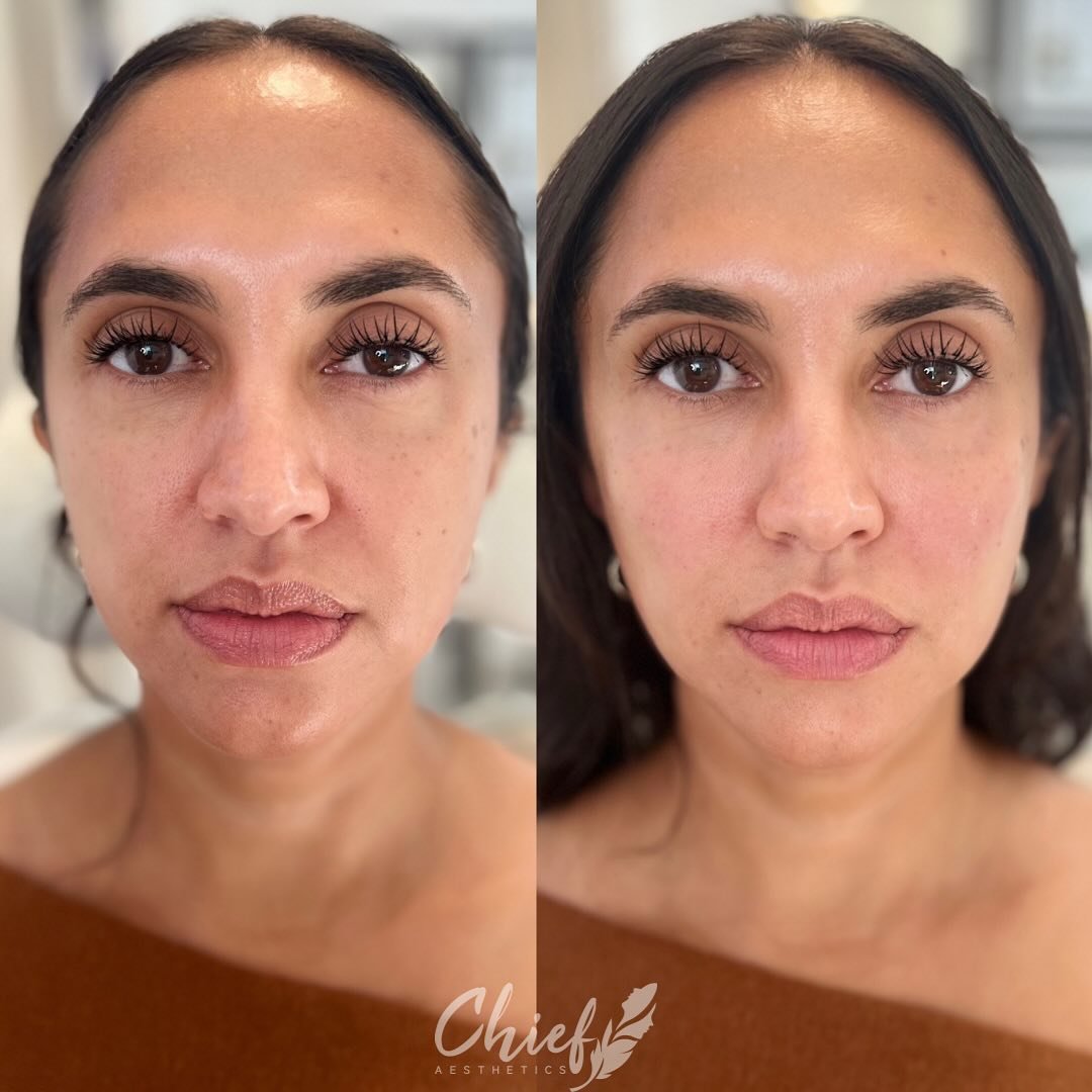 Look at this beautiful and subtle refresher. 
💉This patient was concerned with undereye hollowing.  We addressed it by doing our signature cheek &amp; undereye treatment.  The key was to support the midface as well, in order to give further correcti