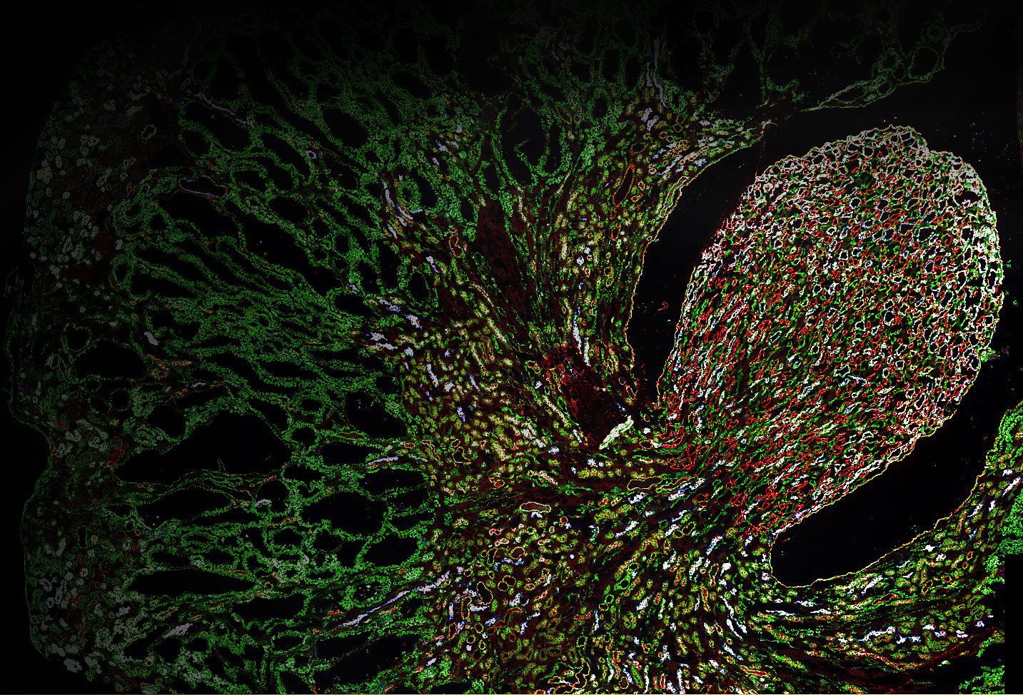 Case 4-2013 — A 50-Year-Old Man with Acute Flank Pain