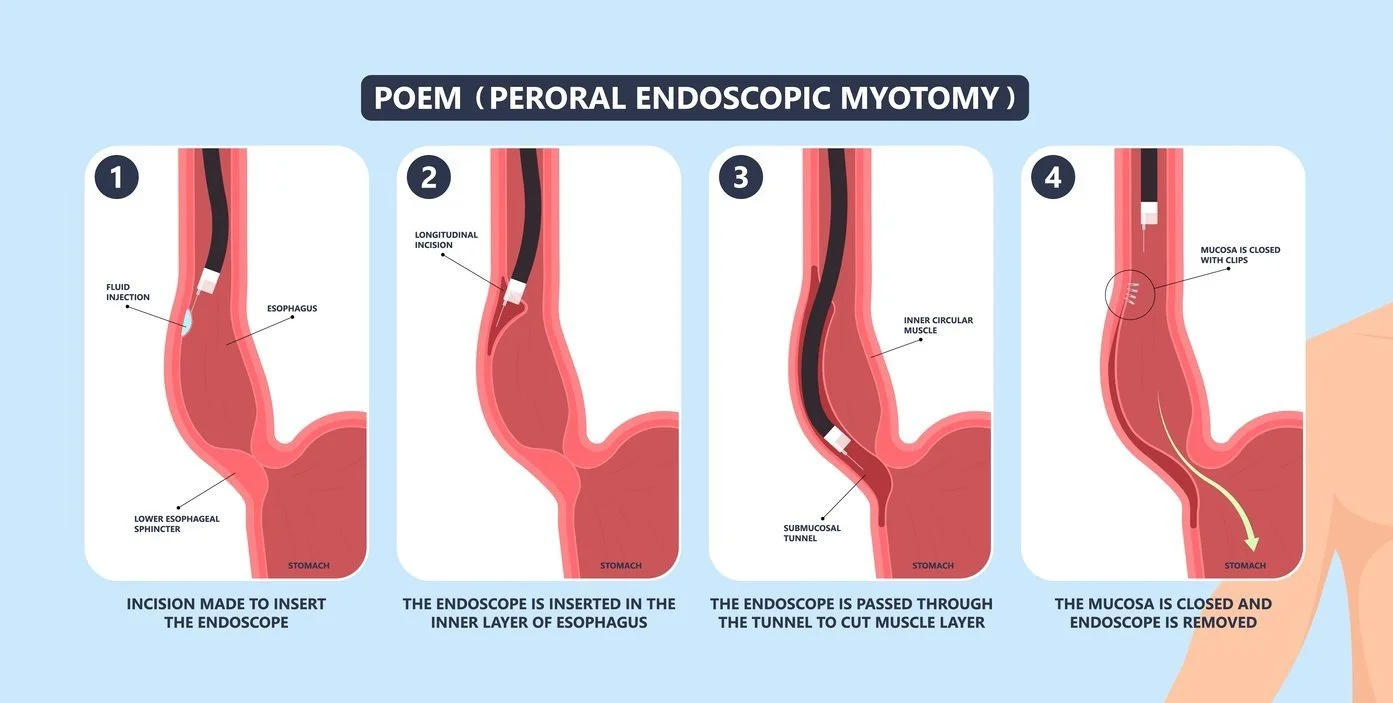 Endoscopy (Peroral Endoscopic Myotomy (POEM)) — Surgical Care HK 信建微創外科中心