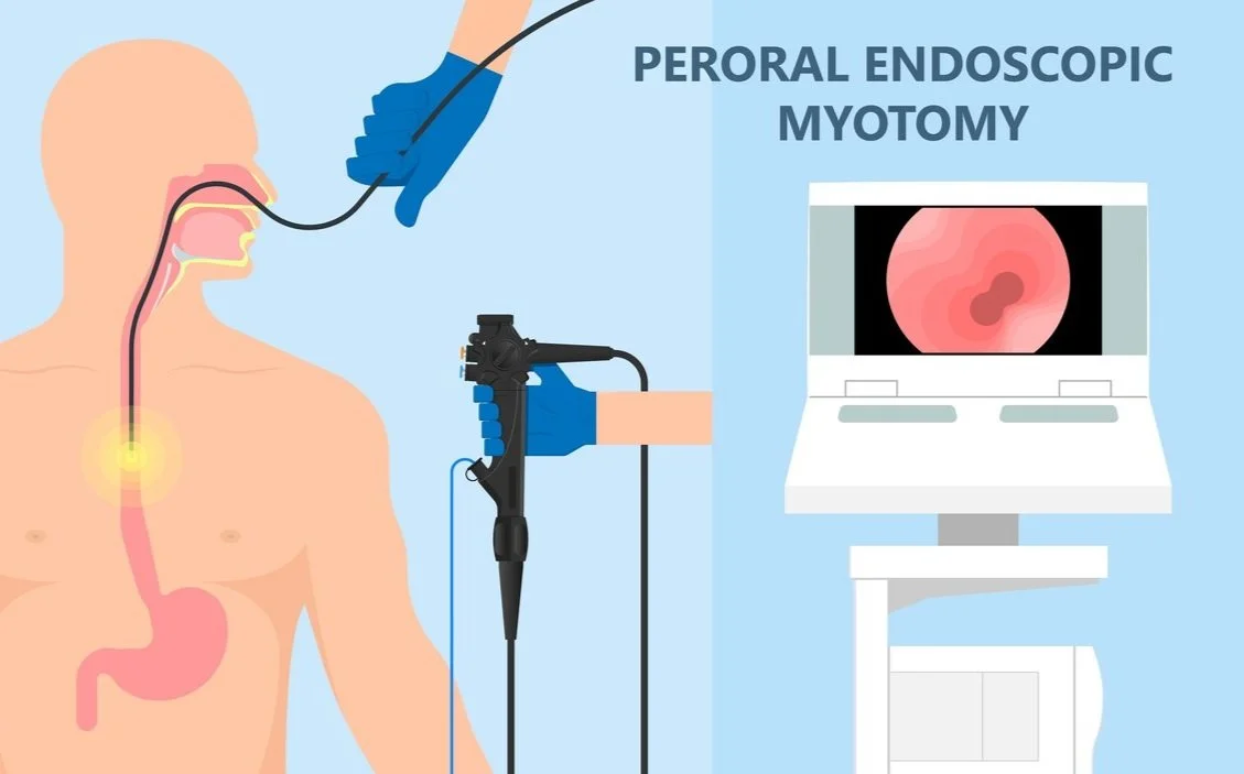 Endoscopy (Peroral Endoscopic Myotomy (POEM)) — Surgical Care HK 信建微創外科中心