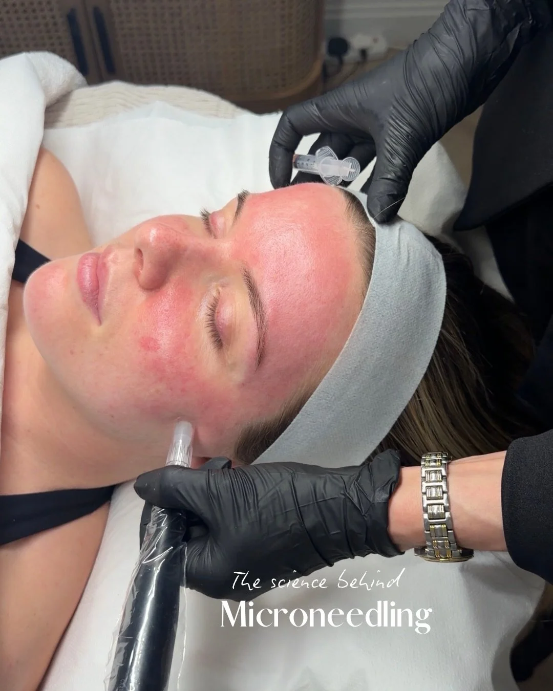 Introducing our newest treatment .. MICRONEEDLING ✨🤩💁🏼&zwj;♀️

I have been busy trialing many serums and skin boosters to bring you the best possible results on this highly requested treatment and the difference to the skin is absolutely incredibl