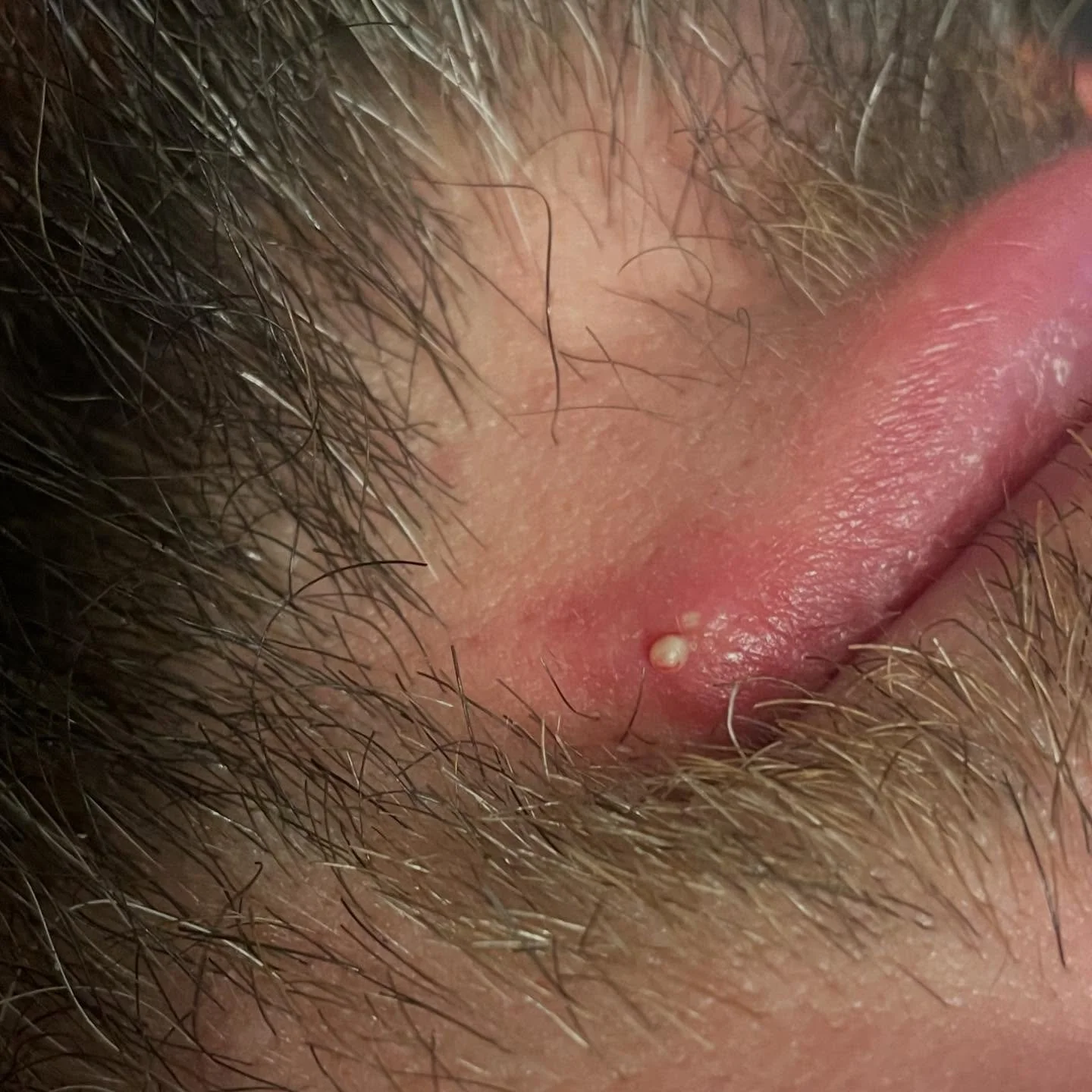 ‼️WARNING‼️ if you don&rsquo;t like pimple popping, keep scrolling 🤪

👉🏼and yes, men need facials too! I pride myself on my technique to extract white heads, black heads and my all time favorite&mdash;MILIA!

📸taken moments after I used a lancet 