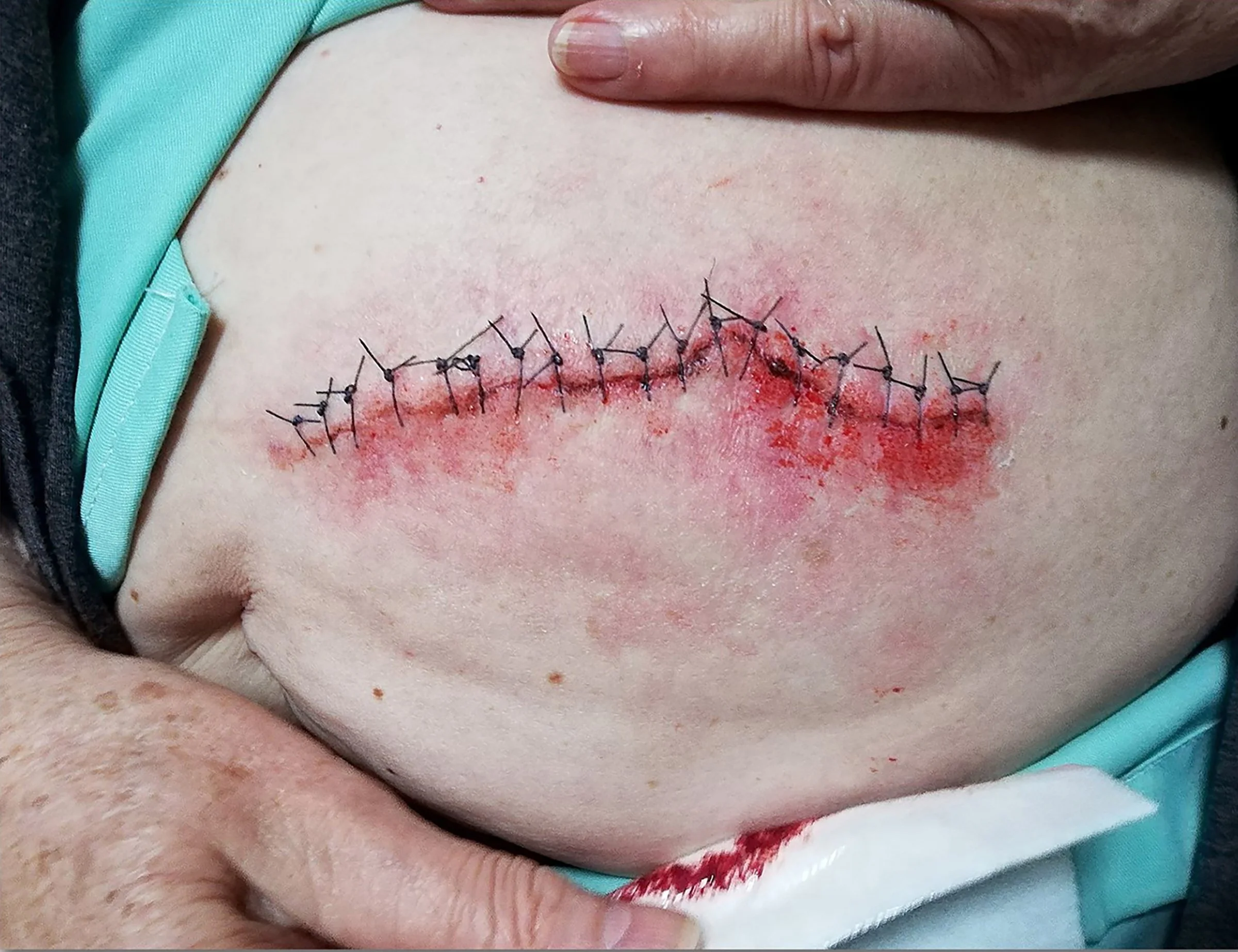 Fabricated & Applied Bondo Transfer Prosthetic Wound.