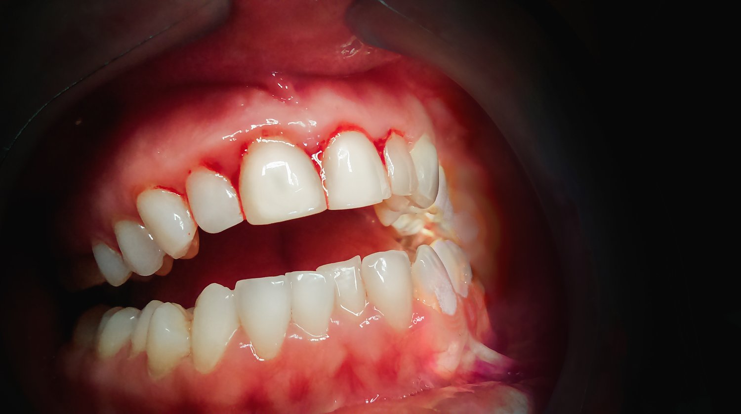 Bleeding Gums: Causes, Treatment, and Prevention - SmartMouth