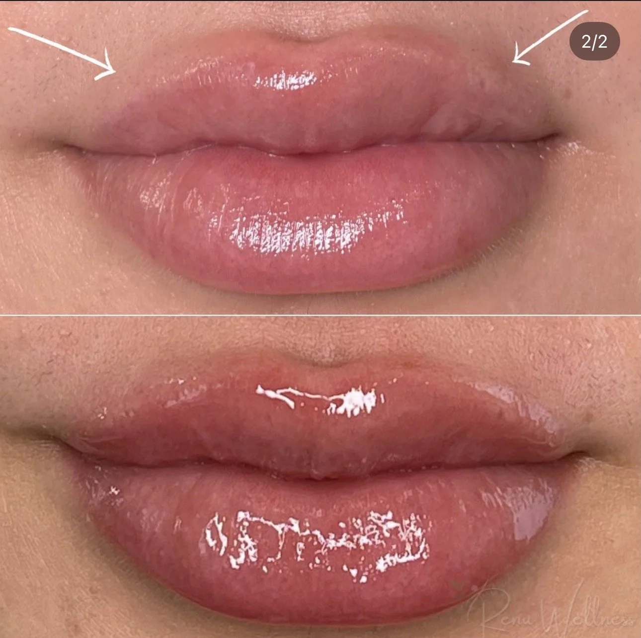 Before and after lip filler treatment in Staten Island at Renu Wellness