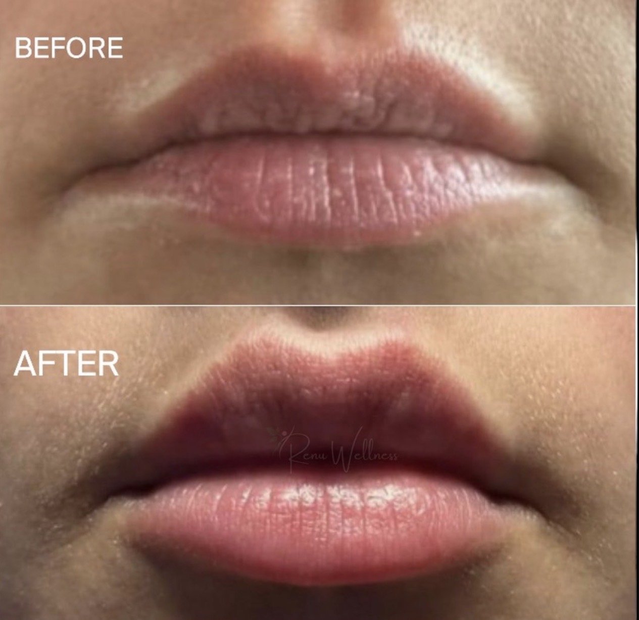 Before and after lip filler treatment in Staten Island at Renu Wellness