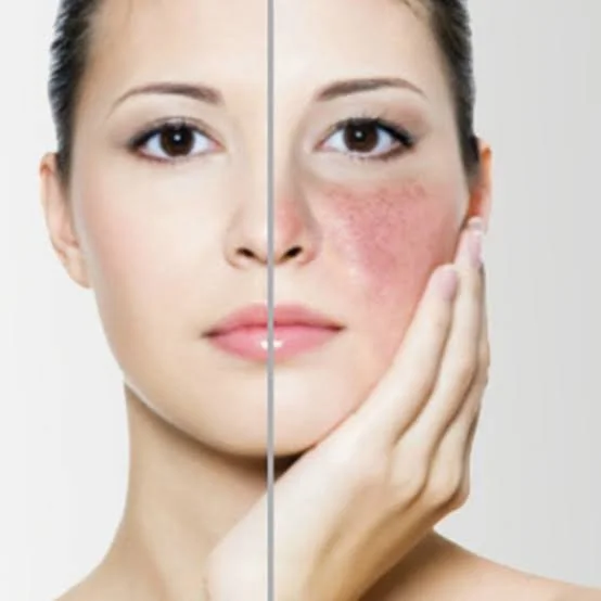 Thread Vein Removal