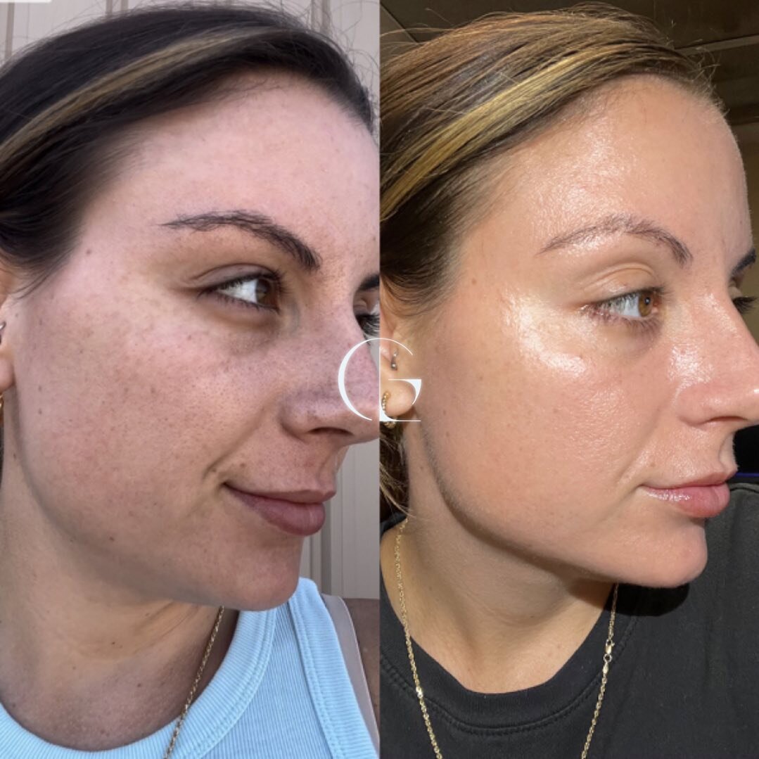 BEFORE &amp; AFTER 
This is a before and after of a virtual consultation. 
✖️Photos were taken 3 weeks apart from each other. 
✖️Switching entire routine and now only using @zoskinhealth 
_____ _____ _____ _____
🗓️Tap BOOK NOW to start transforming 