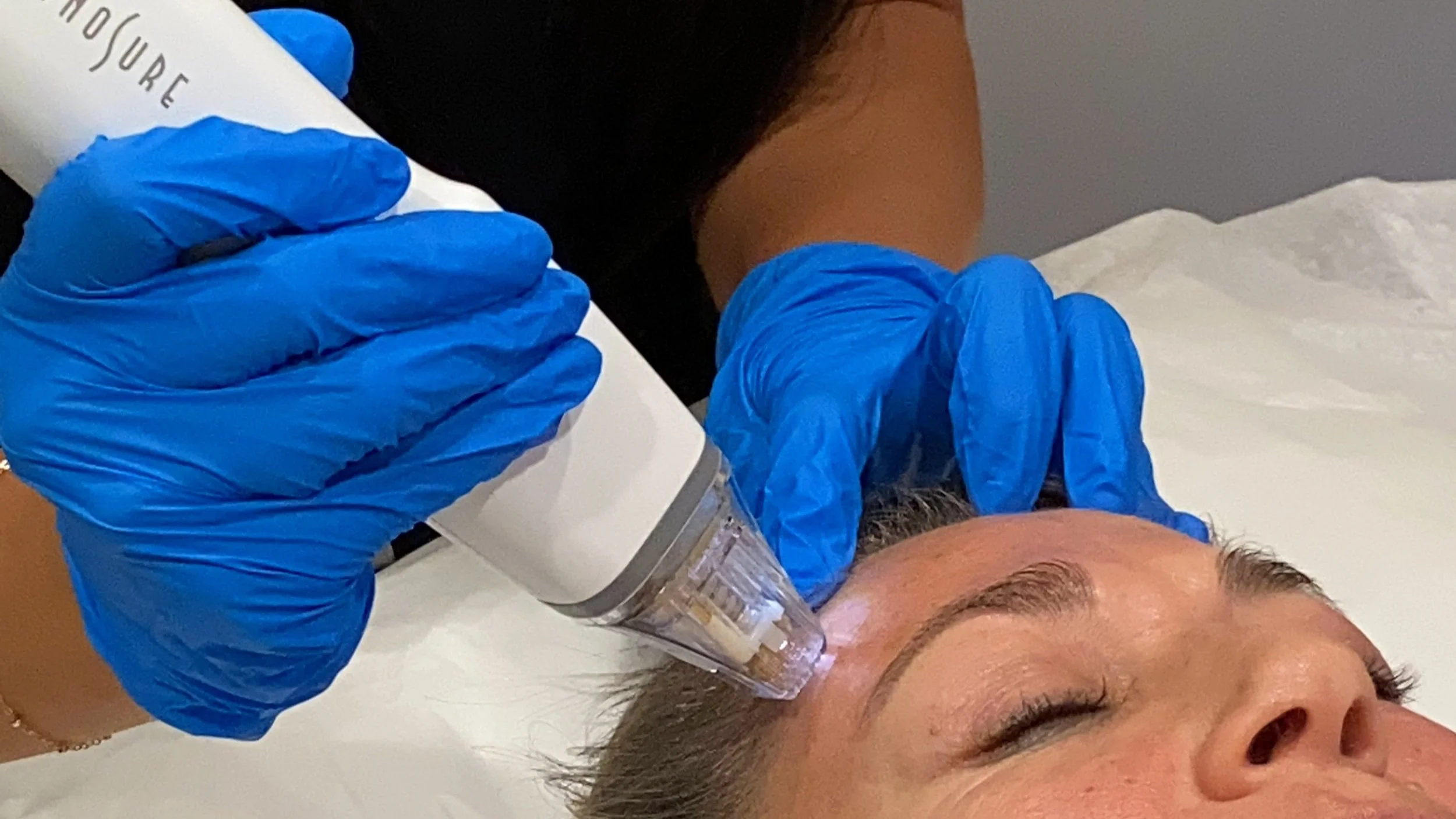 RF Microneedling