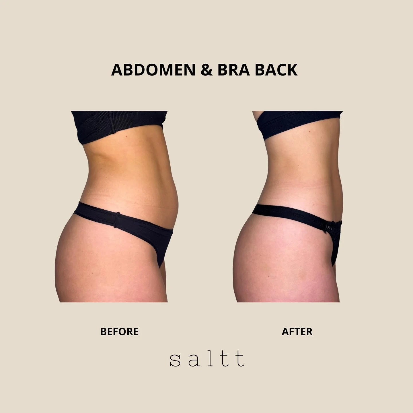 Transformations that speak for themselves&hellip;

Fat freezing is a gentle and non-invasive way to contour and sculpt even the most stubborn areas of the body.

Want to find out more? Book your consult at SALTT today 🤍

#FatFreezingResults #NonInva