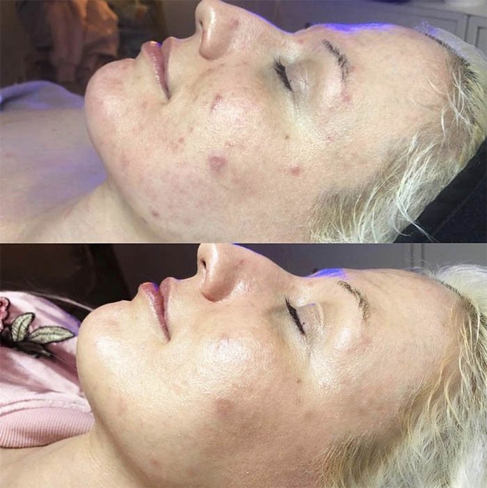 Tanya Martin Acne Before and After 2.jpg