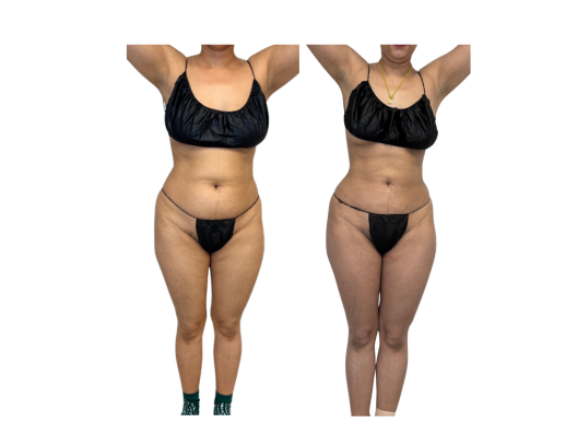 MS pre and post front.png