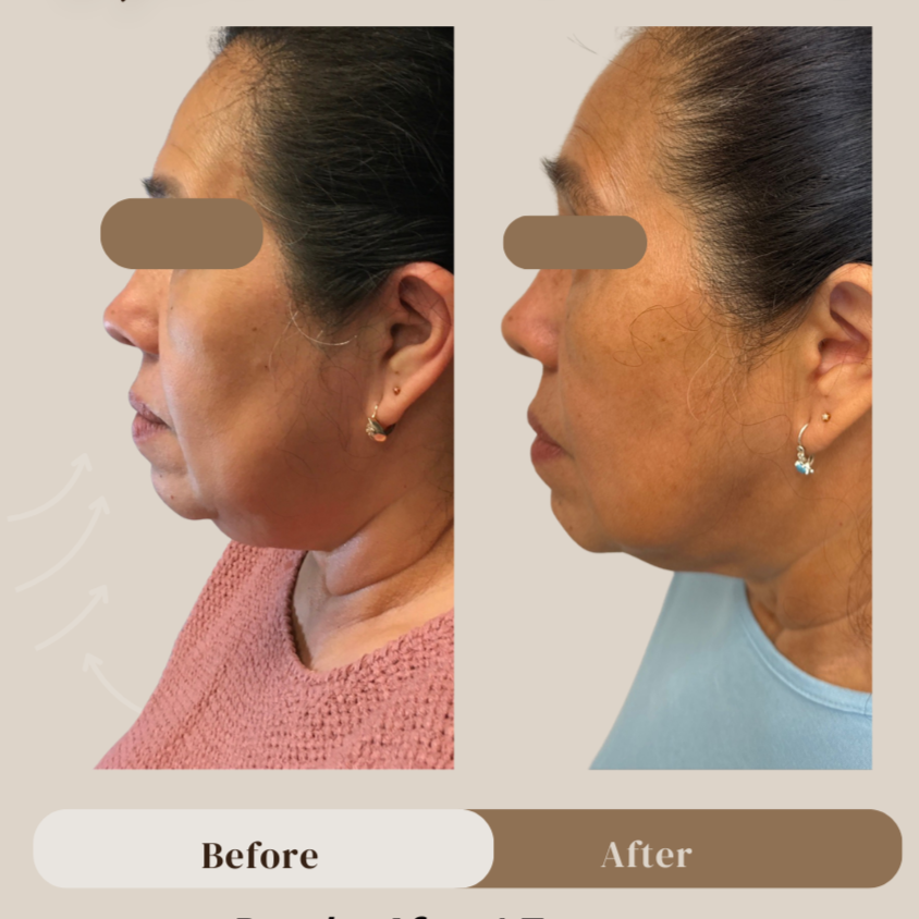 Endolift 3 months postop (1 session)