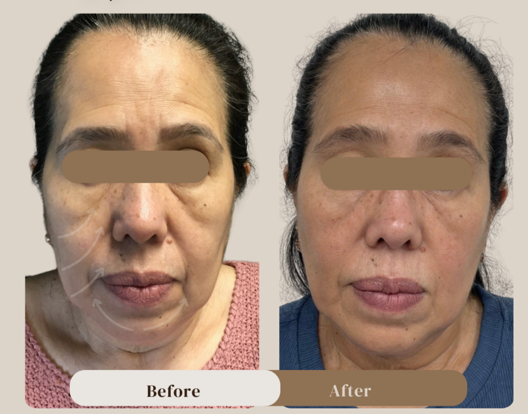 Endolift (6 months postop) 2 sessions