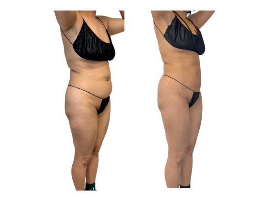 ms before and after rt 45 pre and post.png