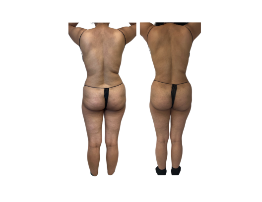 before and after ms back (Postcard (US)).png