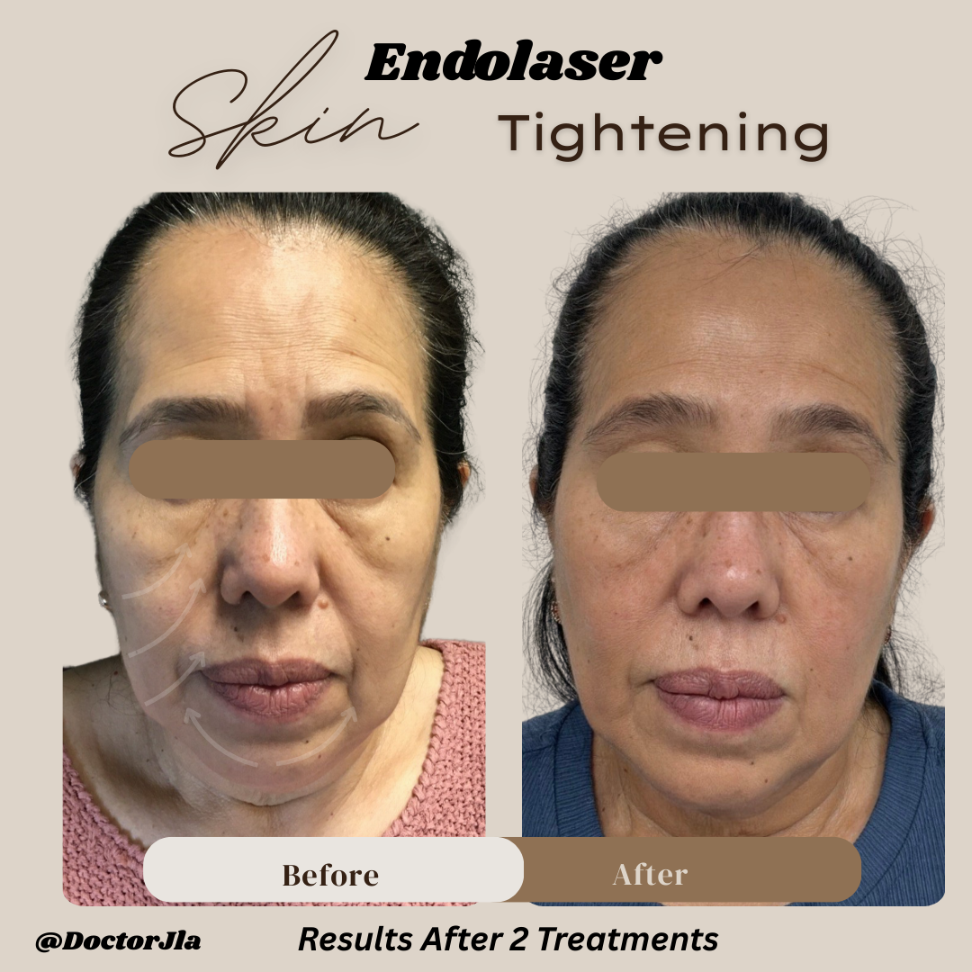 Endolaser skin tightening