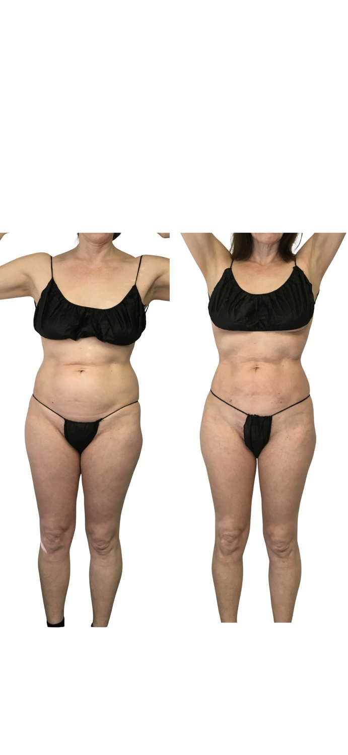 front Kim b +after.png