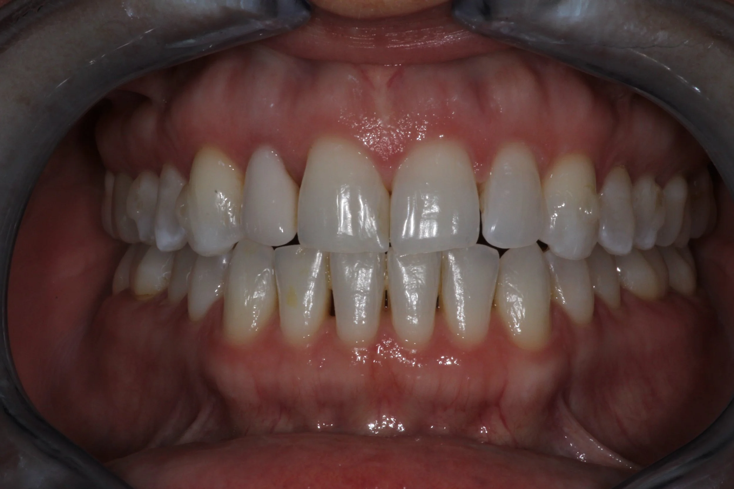 veneers before1.jpg