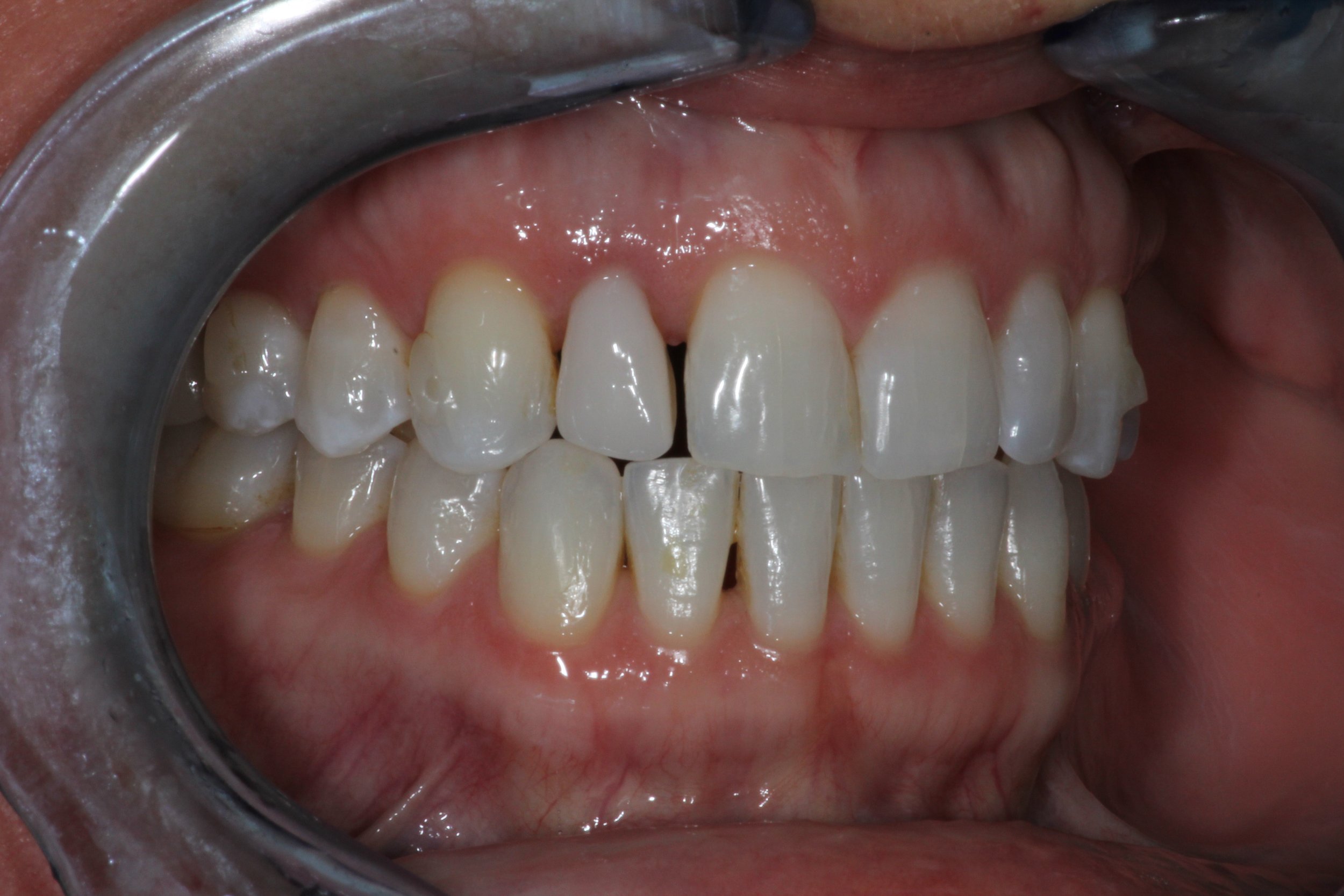 veneers before2.jpg