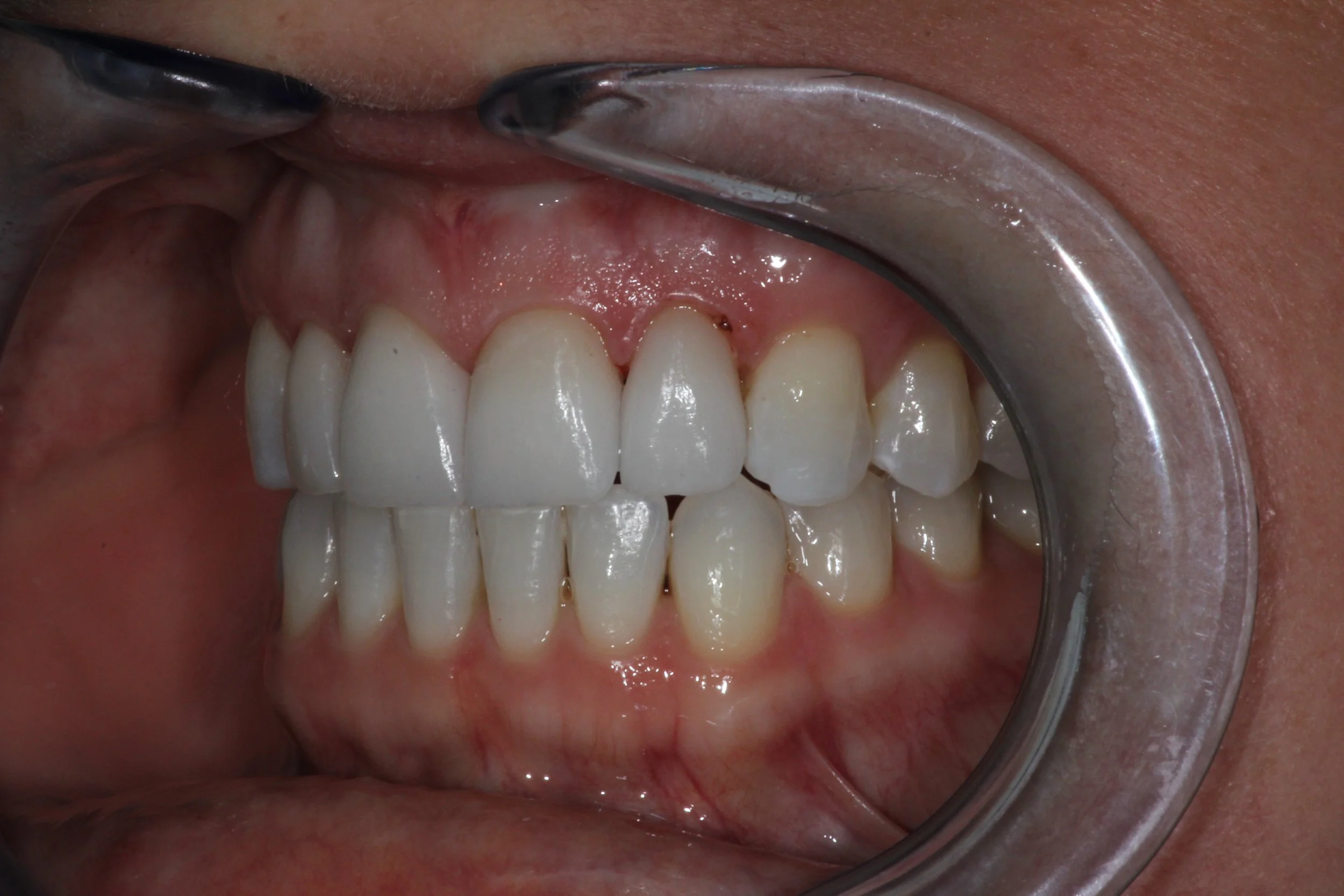 veneers after3.jpg