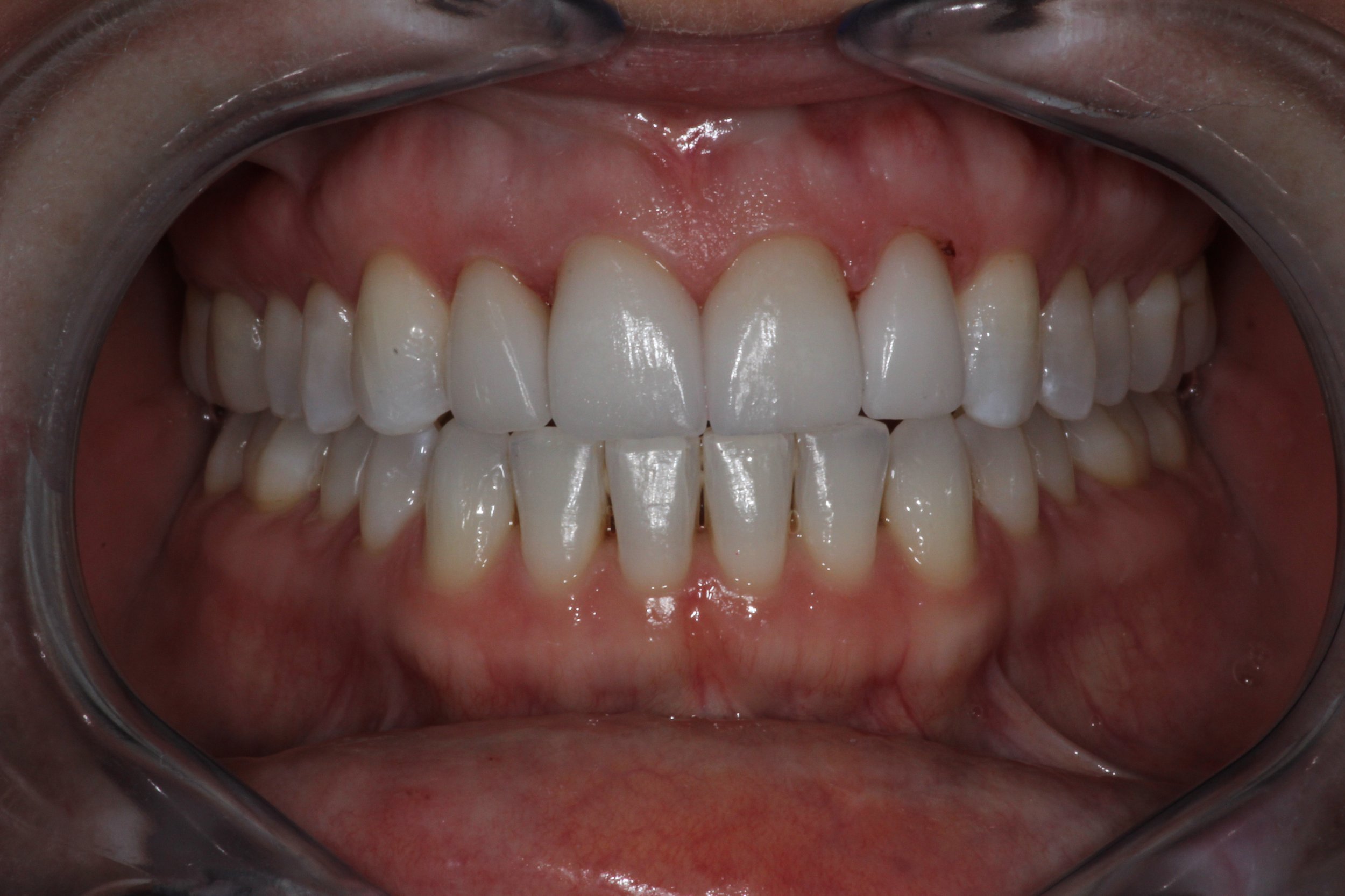 veneers after1.jpg
