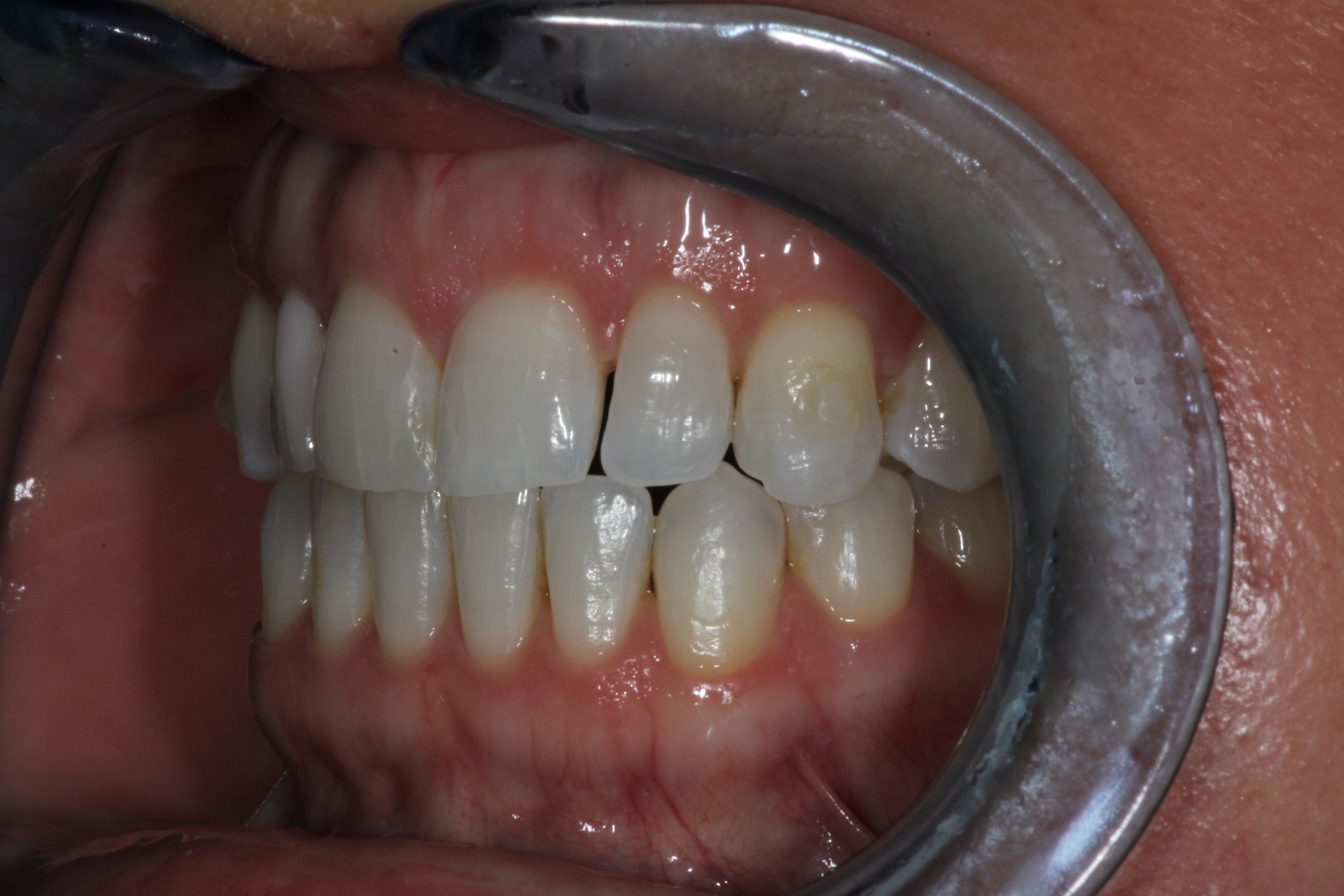 veneers before3.jpg