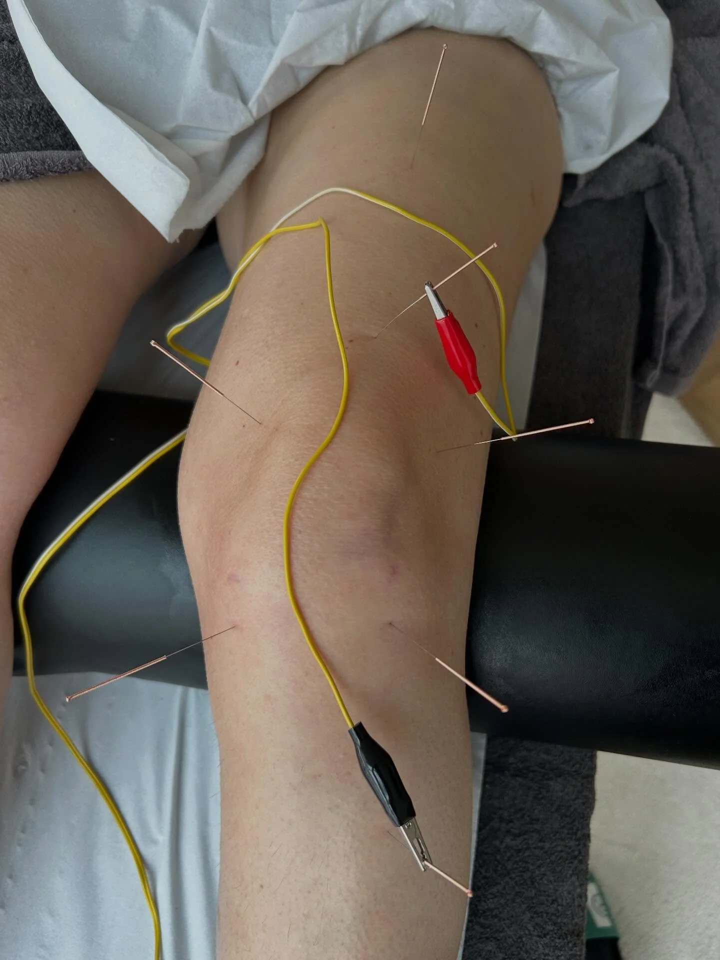 Saturday I performed treatment for osteoarthritis in the knee! 

Osteoarthritis is a joint decease where the protective cartilage to the bone ends starts to thin or become damaged. 
In turn the space for the knee joint becomes narrowed causing the kn