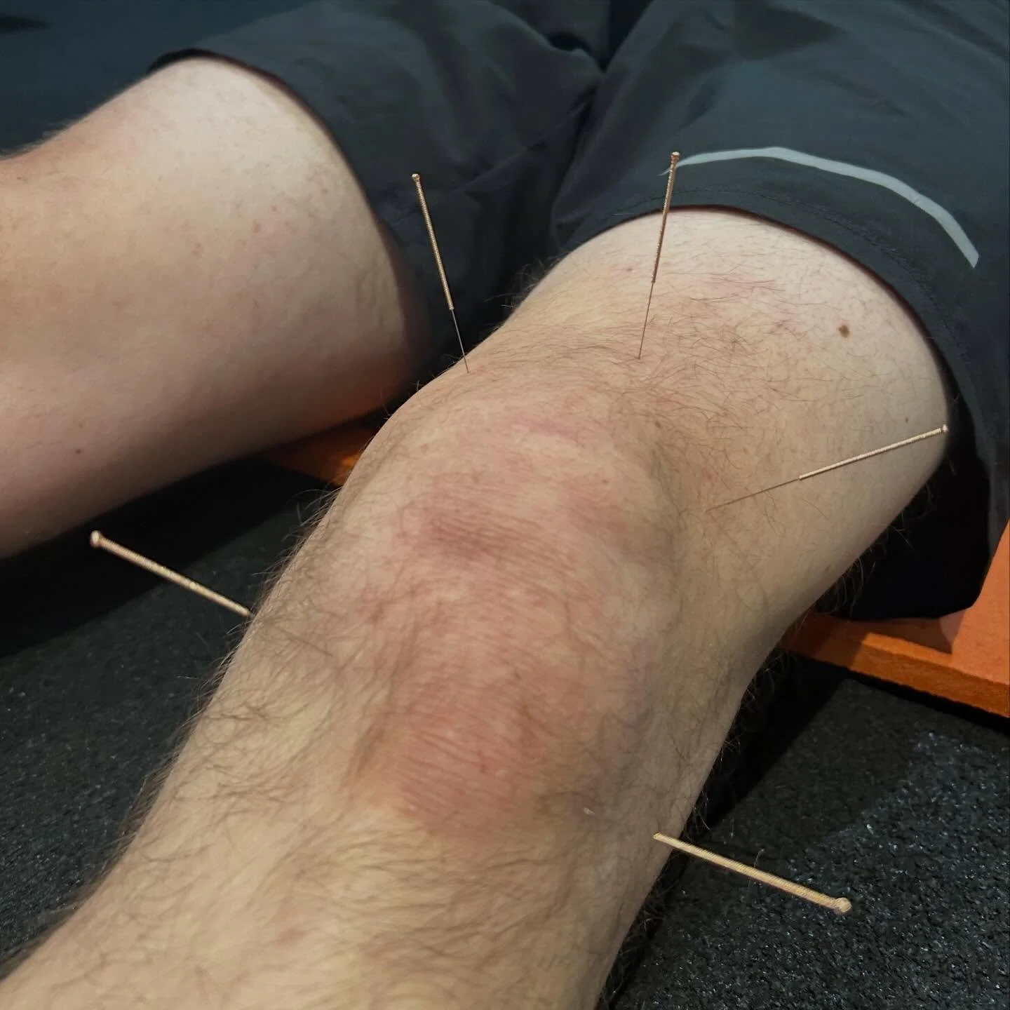 One of the most common injuries I see is with the knee, as with the shoulder and hip it&rsquo;s a complex joint and takes a lot of strain. 

Runners and cyclists especially can suffer with tendinitis in the knee due to overuse. This can show itself a