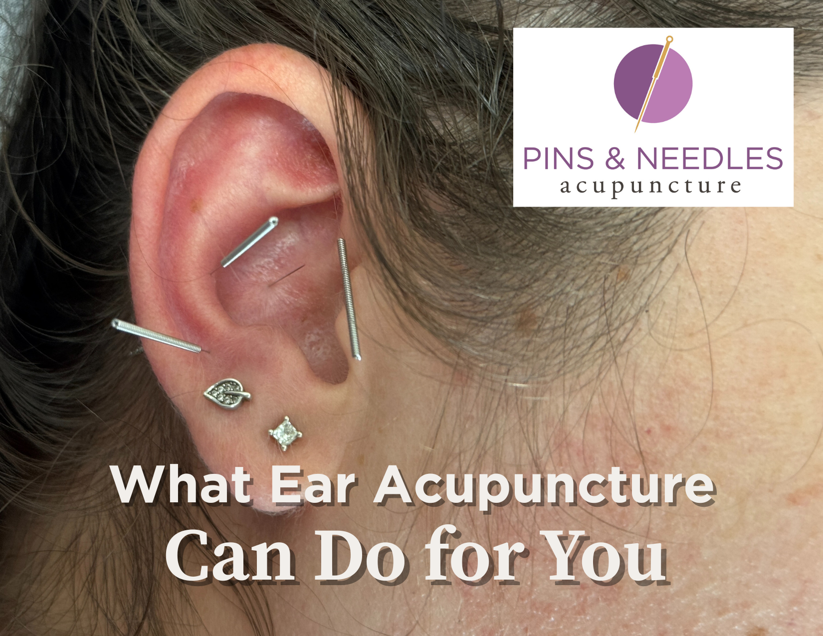 Ear acupuncture